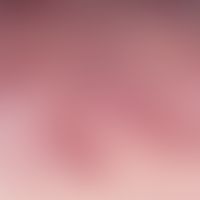 Erythema necrolyticum migrans: anulär migrierende rote Plaques mit&nbsp; Schuppenkrusten. Abb. en...