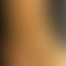 Atrophie blanche: Innenknöchel einer 58jährigen Frau mit Atrophie blanche und Corona phlebectica ...