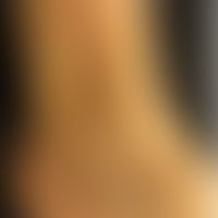 Atrophie blanche: Innenknöchel einer 58jährigen Frau mit Atrophie blanche und Corona phlebectica ...