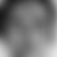 Chloasma/Melasma: beidseitige, chronisch stationäre,&nbsp; symptomlose, braune, glatte Flecken. H...