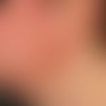 Patch: großflächiges Erythem bei kontaktllergischer Dermatitis
