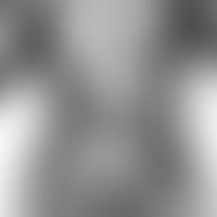 Parakeratosis variegata: historische Ausnahme, aus: Collectiones Medico-Chirugicales, R. Degos 19...