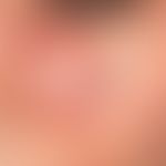 Lupus erythematodes kutaner (Übersicht): chronisch diskoider Lupus erythematodes. Lokalisierter B...