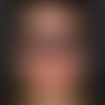 Lupus erythematodes subakut kutaner: dicht stehende, erythematöse Plaques im Gesicht.

&nbsp;
