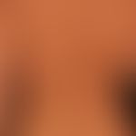 Syphilis:makulos-papulöses Exanthem (Syphilid)
