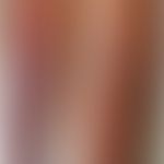 Myxödem prätiabiales (euthyreotes Myxödem):&nbsp;umschriebene,&nbsp;unscharf begrenzte, bräunlich...