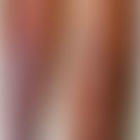 Myxödem prätiabiales (euthyreotes Myxödem):&nbsp;umschriebene,&nbsp;unscharf begrenzte, bräunlich...