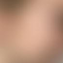 Pityriasis simplex faciei:&nbsp;scheibenförmige, mäßig scharf demarkierte, völlig symptomlose wei...