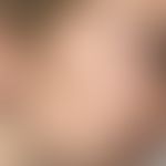 Pityriasis simplex faciei:&nbsp;scheibenförmige, mäßig scharf demarkierte, völlig symptomlose wei...