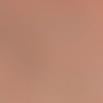 Dfferenzialdiagnose:&nbsp;Sklerodermie zirkumskripte kleinfleckige

Diagnose: Lichen sclerosus ex...