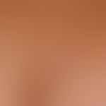 Differnezialdiagnose: Sklerodermie zirkumskripte kleinfleckige

Diagnose: Lichen sclerosus extrag...