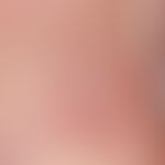 Köhlmeier-Degos-Krankheit assoziativ zu einem systemischenLupus erythematodes. Spritzerartige Atr...