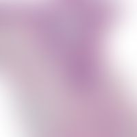 Myxom kutanes: Zusammentreffen einer epithelialen Zyste mit einem kutanen Myxom. Abb. entnommen a...