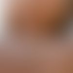 Muzinose solitäre kutane fokale: kleines unspektakuläres, asymptomatisches, hautfarbenes Knötchen...