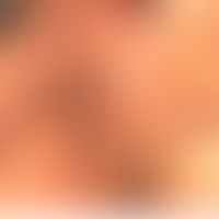Follikulärer muzinöser Naevus:&nbsp;in den Blaschko-Linien angeordnetes&nbsp;epitheliales Hamarto...