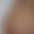 Muzinose akrale persistierende, papulöse: multiple 0,2-0,4 cm große hautfarbene, asymptomatische,...