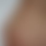 Muzinose akrale persistierende, papulöse: multiple 0,2-0,4 cm große hautfarbene, asymptomatische,...