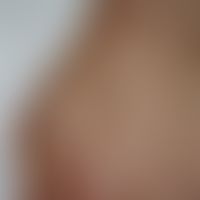 Muzinose, akral persistierende: multiple 0,2-0,4 cm große hautfarbene, asymptomatische, flache&nb...