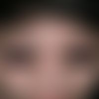 Muzinose kutane infantile selbstheilende: akute, ödematöse (Dermatomyositis-artige)Gesichtsschwel...