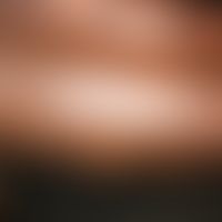 Dermatitis cruris pustulosa et atrophicans: Unterschenkel&nbsp;einer jungen ugandischen Frau. Zah...