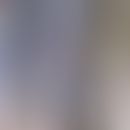 Podoconiosis:&nbsp; 85 Jahre alte Patientin aus Uganda. Chronische Podokoniose mit wachsartiger V...