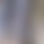 Podoconiosis:&nbsp; 85 Jahre alte Patientin aus Uganda. Chronische Podokoniose mit wachsartiger V...