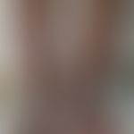 Podoconosis: knotige Papillomatose mit(bakteriellen) Sekundärinfektionen. Abb. enommen aus: Enbia...