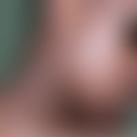 Pityriasis rosea: Exanthem mit grau-braunen flach elevierten Papeln und Plaques. Die Plaques mit ...