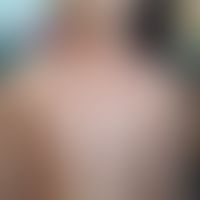 Pityriasis rosea: untpyischer, ausgeprägter Befall der Halsregion: Abb. entnommen aus:&nbsp;Ermer...