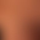 Pityriasis rosea inversa:&nbsp; Ungewöhnliches "inverses" Verteilungsmuster einer ansonsten regel...