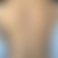 Pityriasis rosea: dichtes makulo-papulöses Exanthem, angedeutete Anordnng in den Spaltlinien.&nbs...