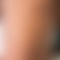 Pityriasis rosea: Exanthem&nbsp;mit unterschiedlich großen, flach papulösen bzw. plaquförmigen, r...