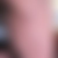 Pityriasis rosea: Exanthem&nbsp;mit unterschiedlich großen, flach papulösen bzw. plaquförmigen, r...