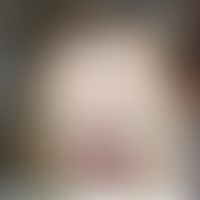 Mevalonazidurie: rote, wenig symptomatische Plaque.&nbsp;Abb. entnommen aus&nbsp;Pace S et al. (2...