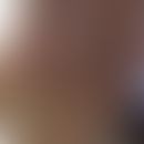 Multiple selbstheilende Palmoplantarkarzinome: Abbildung entnommen aus&nbsp;Scheufele C et al. (2...