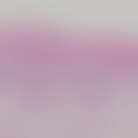 Keratosis lichenoides chronica: superfizielle epidermotrope Dermatitis mit geringer Akanthose und...