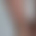 Keratosis lichenoides chronica: ausgeprägte bräunliche Paplen und Plaques, teils in streifiger An...