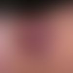 Merkelzell-Karzinom: Frau, 93 Jahre. An der Oberseite linker Unterarm.&nbsp;
