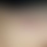 Merkelzell-Karzinom (Metastase): Frau, 94 Jahre. Zn Merkelzellkarzinom Unterarm links vor 9 Monat...