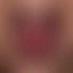 Keratosis lichenoides chronica:&nbsp;flächige erosive und vernarbte Plaques bei einem Kind. Abbil...