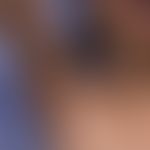 Keratosis lichenoides chronica:&nbsp;streifige und flächige veruköse Plaques bei einem Kind. Abbi...