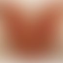 Neutrophile Dermatose der Handrücken: akute aufgetretene, fieberhafte,&nbsp;rote Plaques. Abb. en...