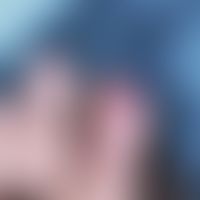 Parakeratosis pustulosa:&nbsp;subunguale und paraunguale Pustulation.&nbsp;&nbsp;Abb. entnommen a...