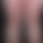 Erythema anulare centrifugum: teils flächige, teil anuläre rote Plaques. Ursächlich wird eine chr...