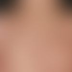 Erythema anulare centrifugum: polyzyklische peripher schuppige Plaques bei einem 8-jährigen Junge...