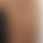 Erythema anulare centrifugum: seit 1 Woche bestehende Hauterscheinungen, bei&nbsp; bekannter COVI...