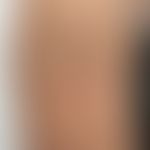 Erythema anulare centrifugum: seit 1 Woche bestehende Hauterscheinungen, bei&nbsp; bekannter COVI...