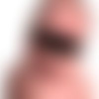 Anuläres Erythem des Säuglings:&nbsp;&nbsp;5 Monate alter Junge mit einer 4-monatigen Vorgeschich...