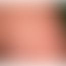 Anuläre lichenoide Dermatitis der Kindheit: scheibenartige, angedeutet anuläre rote Plaques mit g...