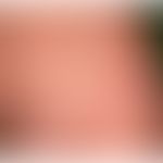 Anuläre lichenoide Dermatitis der Kindheit: scheibenartige, angedeutet anuläre rote Plaques mit g...